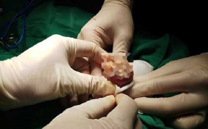 Những nguyên nhân gây ung thư dương vật