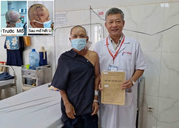 Đắk Lắk: Phẫu thuật thành công khối u “khổng lồ” vùng đầu cho bệnh nhân 58 tuổi