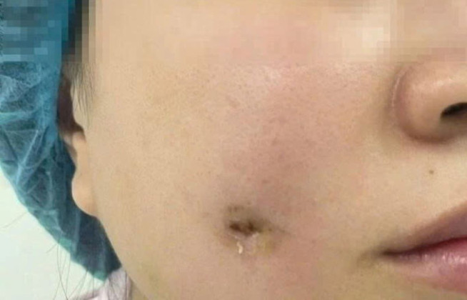 Cô gái bị nhiễm trùng sau khi đi làm má lúm đồng tiền