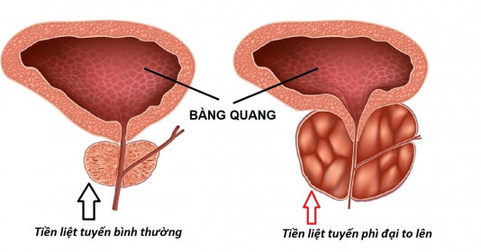 Bệnh phì đại tuyến tiền liệt: Có nên quan hệ tình dục?