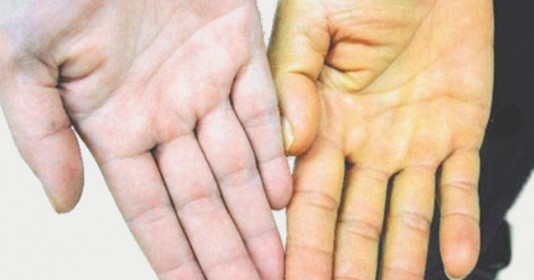 Biểu hiện của viêm gan B giai đoạn đầu: Cảnh báo thầm lặng cần lưu ý