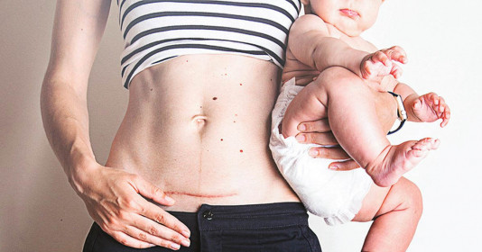 Tất tần tật những điều cần biết về vết mổ sau sinh của mẹ
