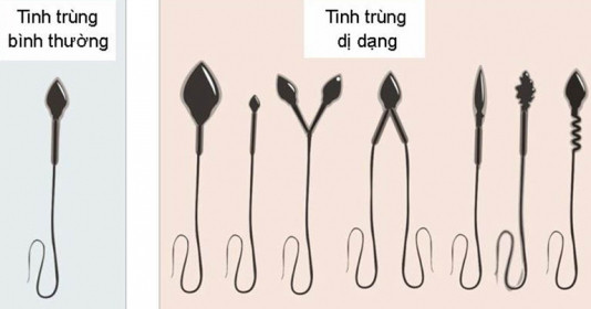 Những thói quen xấu khiến t.inh trùng dị dạng, mách chàng cách điều trị giúp cải thiện rõ rệt