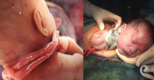 Nguyên nhân gây rau quấn cổ thai nhi và mẹo chữa mẹ nên tham khảo