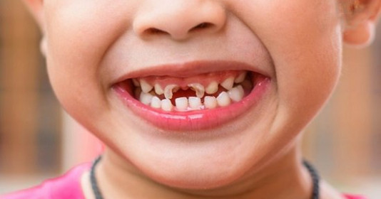 Cách chữa sâu răng cho trẻ, giúp con hết đau nhức hiệu quả