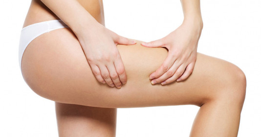 Cách trị rạn da đùi tự tin mặc váy