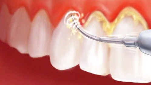  Những lưu ý khi lấy cao răng nếu không muốn hàm răng xấu đi