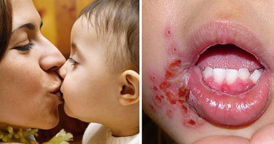 Các virus, vi khuẩn thực sự lây cho trẻ từ một cái hôn