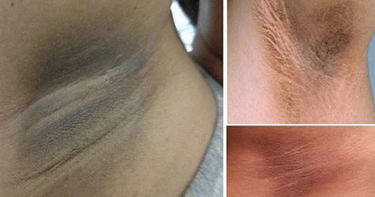 Cách trị thâm nách sau sinh hiệu quả, giúp mang lại làn da mịn màng không tì vết