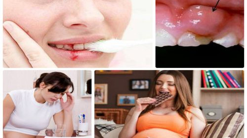 Bà bầu bị sưng lợi chảy máu chân răng thì phải làm sao?
