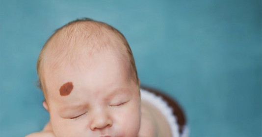 Để con không có bớt chàm xấu xí, mẹ bầu cần chú ý 4 điều này!