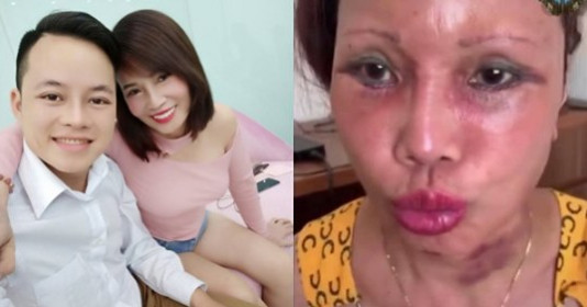 Cô dâu 62 tuổi mặt mũi biến dạng, tím lại vì “níu kéo tuổi xuân”, U70 tuổi thẩm mỹ hết tác dụng