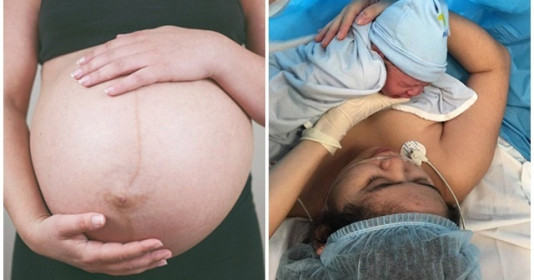Những di chứng sau sinh mổ kéo dài dai dẳng mẹ cần chuẩn bị tâm lý