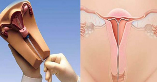 Vòng tránh thai bị tuột phải làm sao? Vòng tránh thai bị tụt thấp có nguy hiểm không?