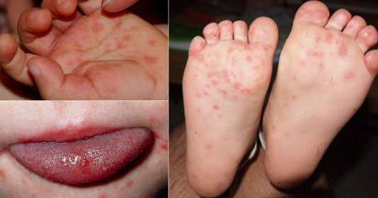 Trẻ bị tay chân miệng cần kiêng những điều này để nhanh khỏi bệnh
