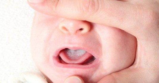Bé bị rộp trắng trong miệng: Nguyên nhân, dấu hiệu và cách xử lý hiệu quả