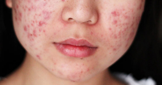 Mặt nổi mụn khi mang thai và những biện pháp giúp giảm mụn trứng cá 