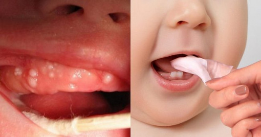 Bé mọc nanh sữa phải làm sao và có nên nhể nanh sữa cho trẻ sơ sinh?