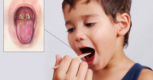 Dịch Bạch Hầu: Những triệu chứng, cách phòng bệnh cho trẻ