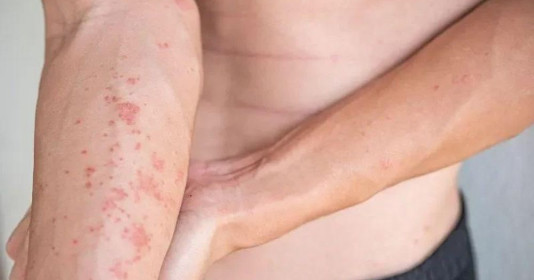 Bác sĩ cảnh báo tình trạng ngứa ngáy khắp nơi, nổi mề đay có thể là dấu hiệu bệnh gan