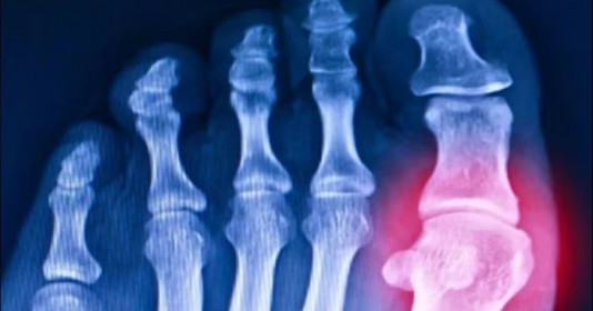 Các nhà khoa học 'hồi sinh' gen 20 triệu năm tuổi giúp chống lại bệnh gout