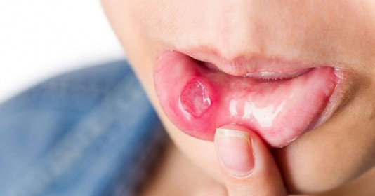 5 mẹo tự nhiên giúp làm dịu vết loét miệng