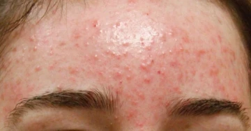 Cách ngăn ngừa mụn trứng cá