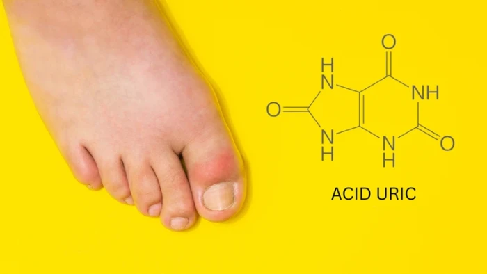 Dấu hiệu thường gặp khi acid uric cao