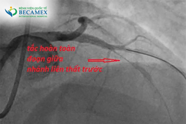 Hút thuốc lá hơn 10 năm, nam bệnh nhân 34 tuổi suýt mất mạng vì nhồi máu cơ tim cấp