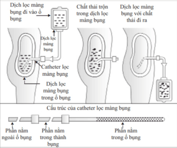 Lọc màng bụng - bước tiến mới trong điều trị bệnh thận mạn tính giai đoạn cuối