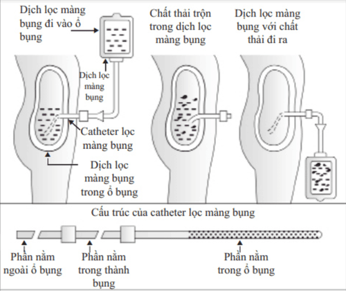 Lọc màng bụng - bước tiến mới trong điều trị bệnh thận mạn tính giai đoạn cuối