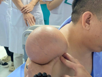 ‘Gỡ bỏ’ khối u vai khổng lồ