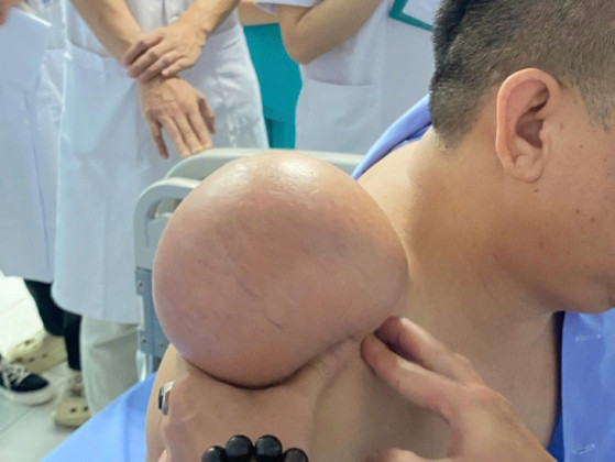 ‘Gỡ bỏ’ khối u vai khổng lồ