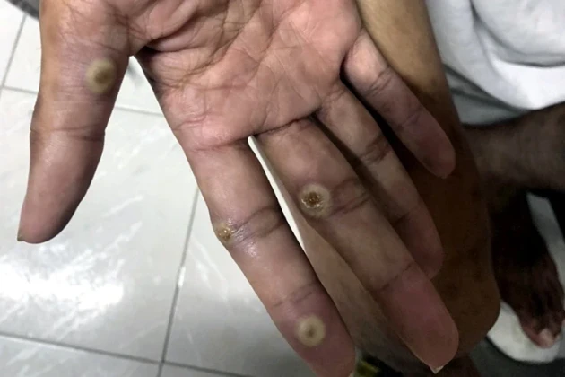 Đồng Nai xuất hiện ca đậu mùa khỉ chưa rõ nguồn lây, ngành y tế khẩn trương truy vết