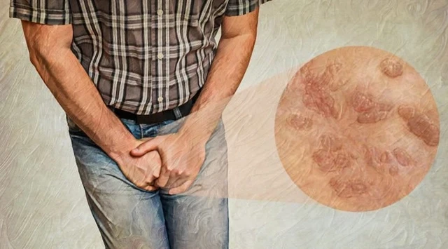 Ung thư dương vật ngày càng trẻ hóa, những dấu hiệu không thể bỏ qua