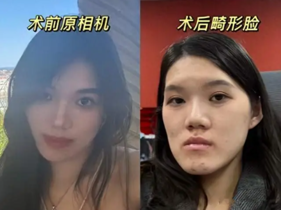 Nữ người mẫu 24 tuổi phẫu thuật thẩm mỹ từ bị móm nhẹ thành mặt lưỡi cày: Lời giải thích của bác sĩ gây phẫn nộ